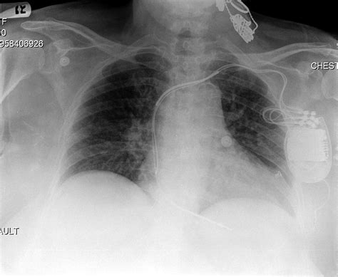 ventricular epicardial lead